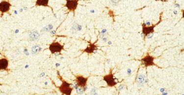 To Understand Brain Disorders, Consider the Astrocyte